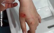 Καστοριά: Σκύλος δάγκωσε κοριτσάκι – Στο νοσοκομείο με τραύματα στα χέρια